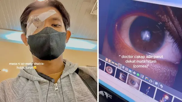 Akibat Sering Kucek Mata Berlebihan, Pria dari Malaysia Harus Jalani Transplantasi Kornea